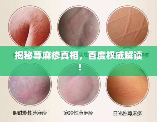 揭秘荨麻疹真相,百度权威解读!