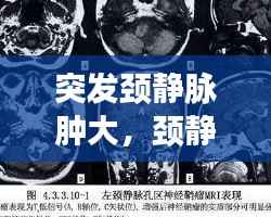 突发颈静脉肿大,颈静脉肿块